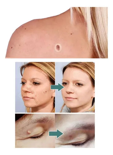 FORMU CLEAR™ Piel libre de verrugas sin dolor ¡216 parches!