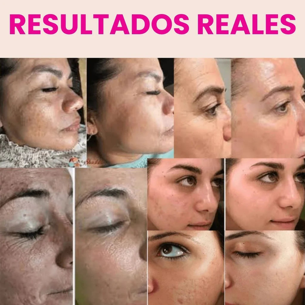 LumiDerma™ Rejuvenece tu piel sin agujas ni filtros desde casa