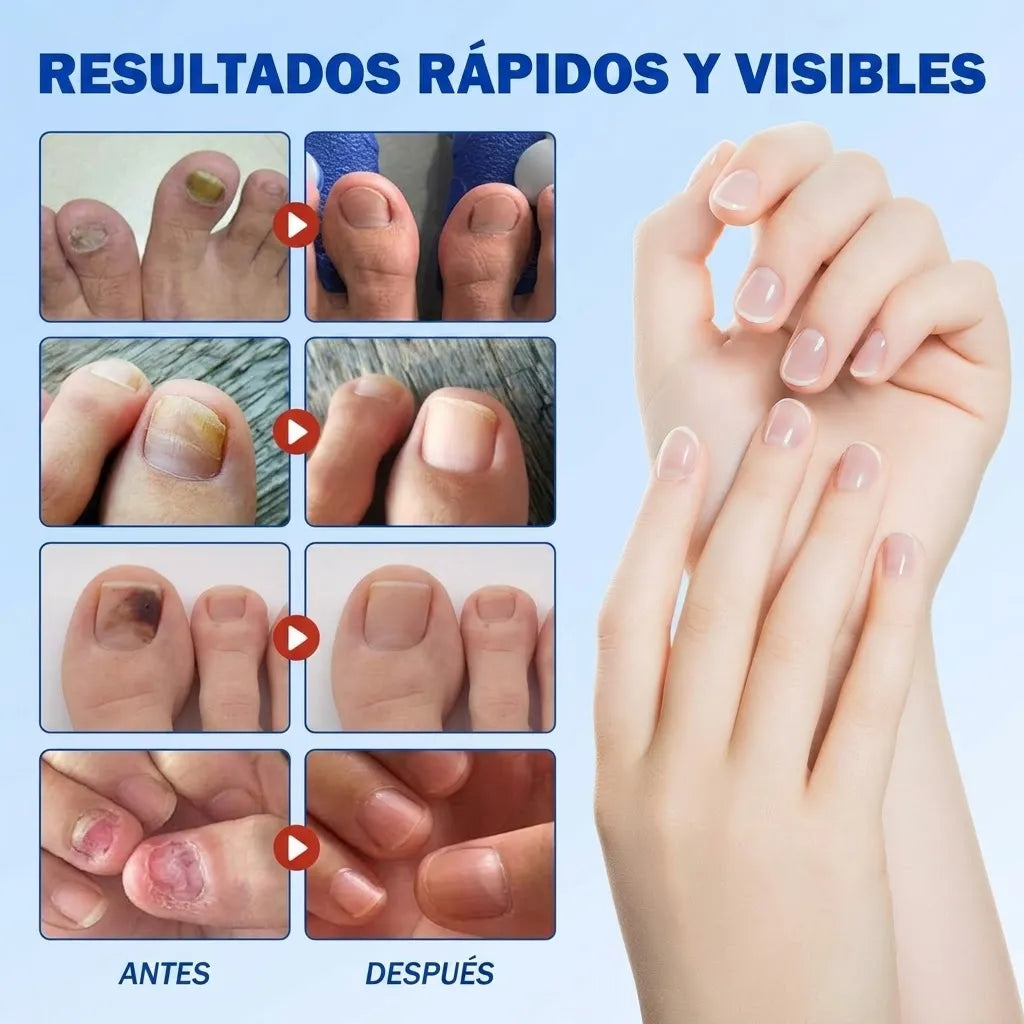 FungiFix™ Parches para Uñas Elimina Hongos 21 Parches