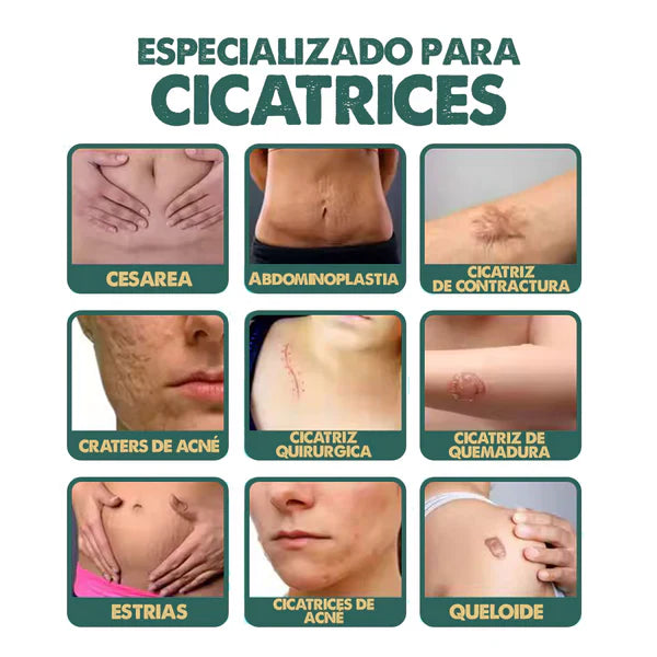 South Moon™ Spray para las Cicatrices y Queloides