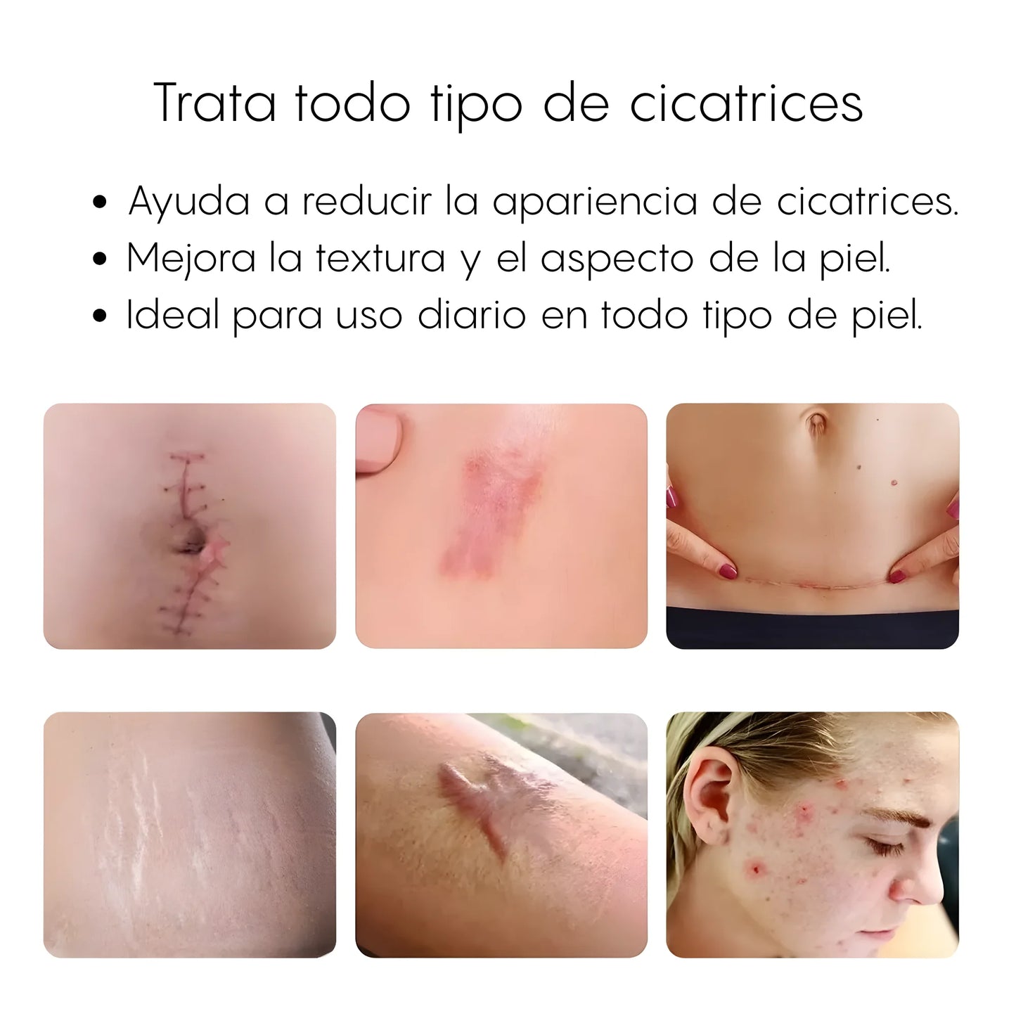 Scar Removal™ Crema Para Cicatrices Profundas