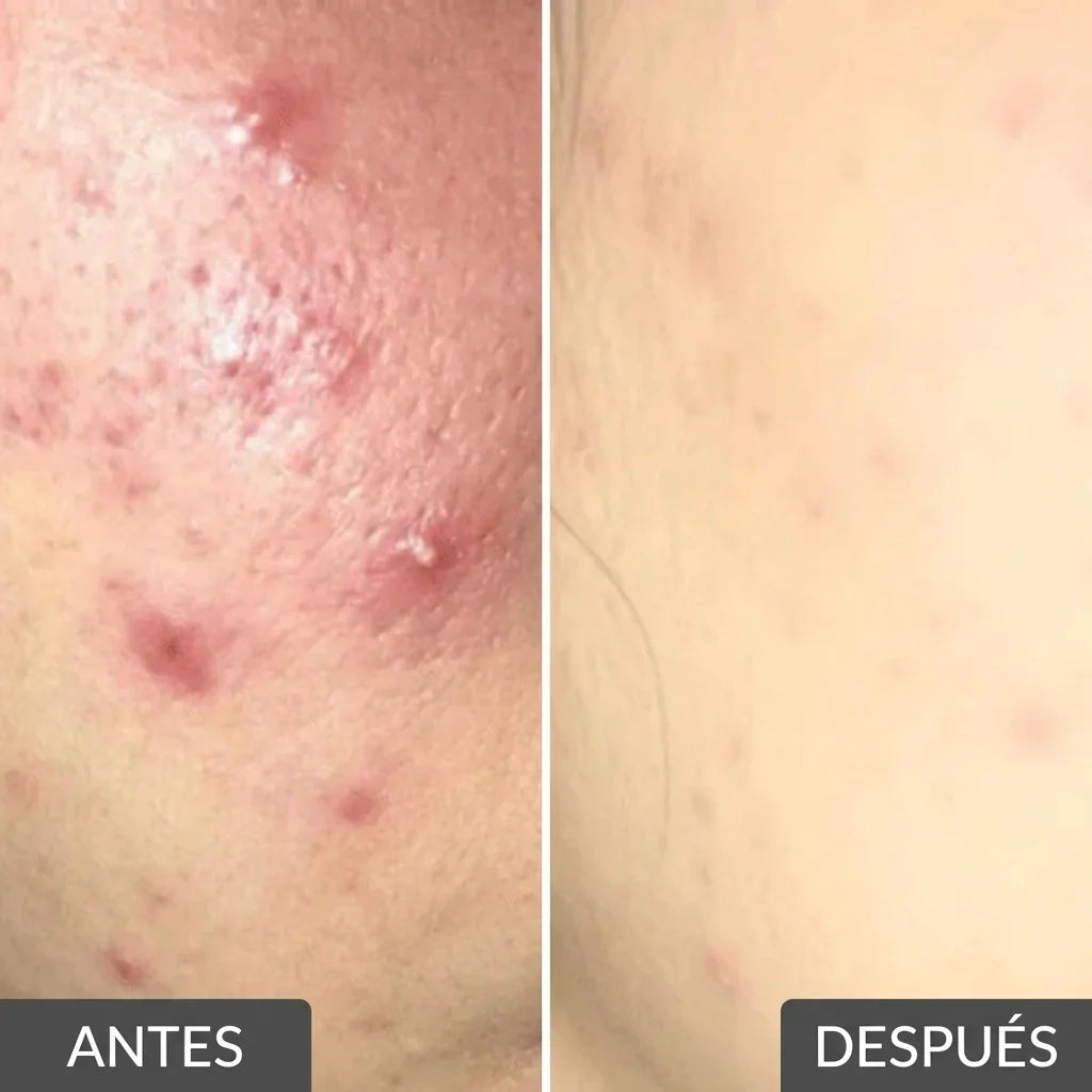 Serum Dr.Leo™ Loción Secante para el Acné