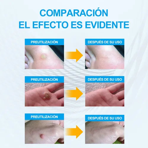 FORMU CLEAR™ Piel libre de verrugas sin dolor ¡216 parches!