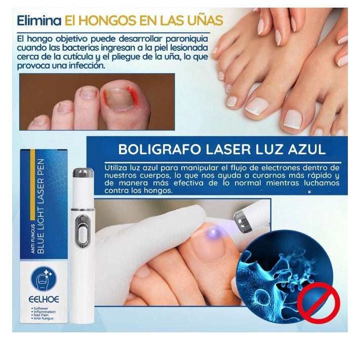 BlueNail Pro™ Lápiz Laser Azul Para Hongos En Las Uñas