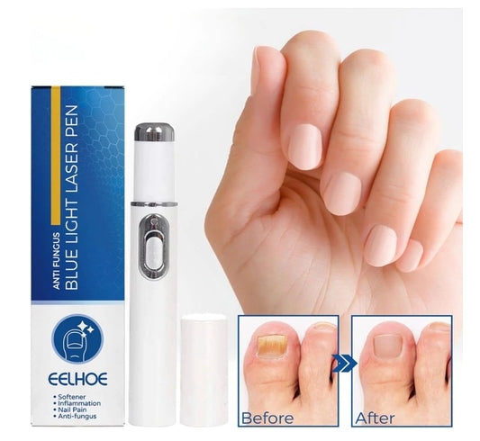 BlueNail Pro™ Lápiz Laser Azul Para Hongos En Las Uñas