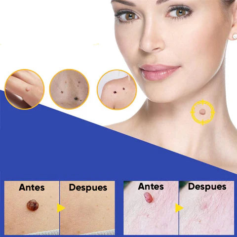 FORMU CLEAR™ Piel libre de verrugas sin dolor ¡216 parches!